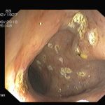 Archivierte Abbildung: features · polypenabtragungen mucosektomien bougierungen von engstellen argon plasma koagulation apc therapie