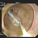 Archivierte Abbildung: features · polypenabtragungen mucosektomien bougierungen von engstellen argon plasma koagulation apc therapie