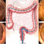 Archivierte Abbildung: features · polypenabtragungen mucosektomien bougierungen von engstellen argon plasma koagulation apc therapie