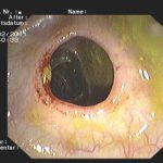 Archivierte Abbildung: features · polypenabtragungen mucosektomien bougierungen von engstellen argon plasma koagulation apc therapie