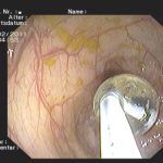 Archivierte Abbildung: features · polypenabtragungen mucosektomien bougierungen von engstellen argon plasma koagulation apc therapie
