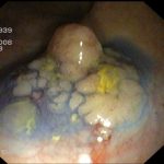 Archivierte Abbildung: features · polypenabtragungen mucosektomien bougierungen von engstellen argon plasma koagulation apc therapie