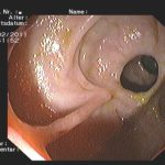 Archivierte Abbildung: features · polypenabtragungen mucosektomien bougierungen von engstellen argon plasma koagulation apc therapie
