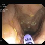 Archivierte Abbildung: features · polypenabtragungen mucosektomien bougierungen von engstellen argon plasma koagulation apc therapie