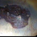 Archivierte Abbildung: features · polypenabtragungen mucosektomien bougierungen von engstellen argon plasma koagulation apc therapie